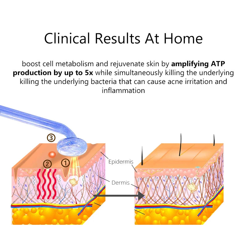 High Frequency Facial Machine - Anti Aging & Acne Therapy