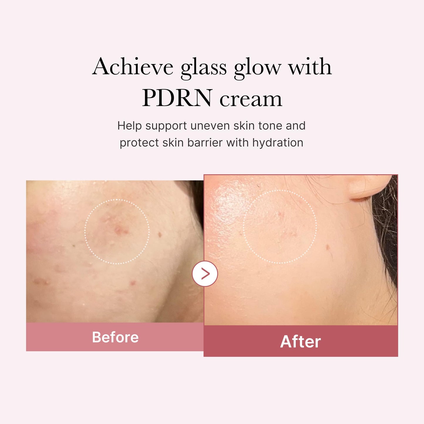 PDRN Pink Hyaluronic Cream - Blemish Relief & Hydration